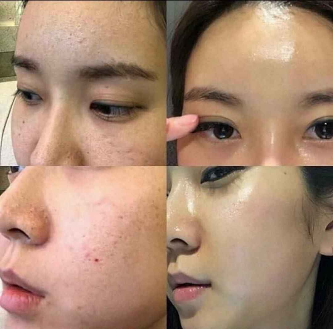 Những cấp độ của Peel da là gì?