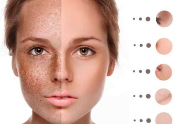 Chăm sóc da chuyên biệt để điều trị tàn nhang