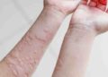 Mề đay làm người bệnh cực kỳ khó chịu