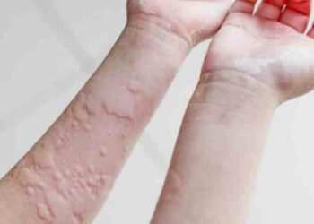 Mề đay làm người bệnh cực kỳ khó chịu