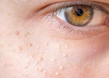 Mụn thịt tuy lành tính nhưng hậu quả của nó cũng khó lường