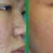 Cần biết những đặc điểm nhận dạng nào về sẹo rỗ?