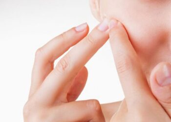 Cách điều trị mụn viêm bằng thuốc được kê đơn