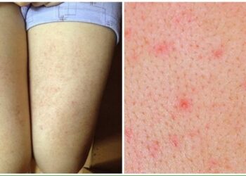 Cách trị viêm nang lông ở chân bằng lá trầu không