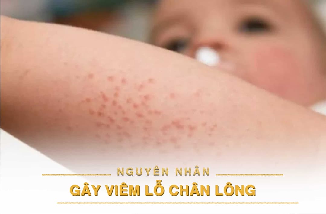 Nguyên nhân bị viêm nang lông ở chân