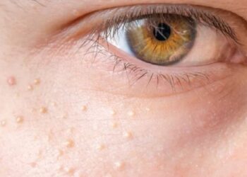 Bạn đã biết mụn thịt là gì chưa?