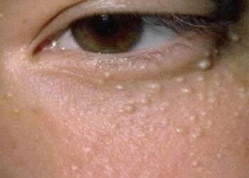 Dấu hiệu nhận biết tình trạng này