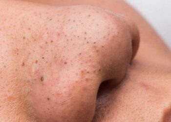 Mụn đầu đen thường xuất hiện ở vùng da mũi