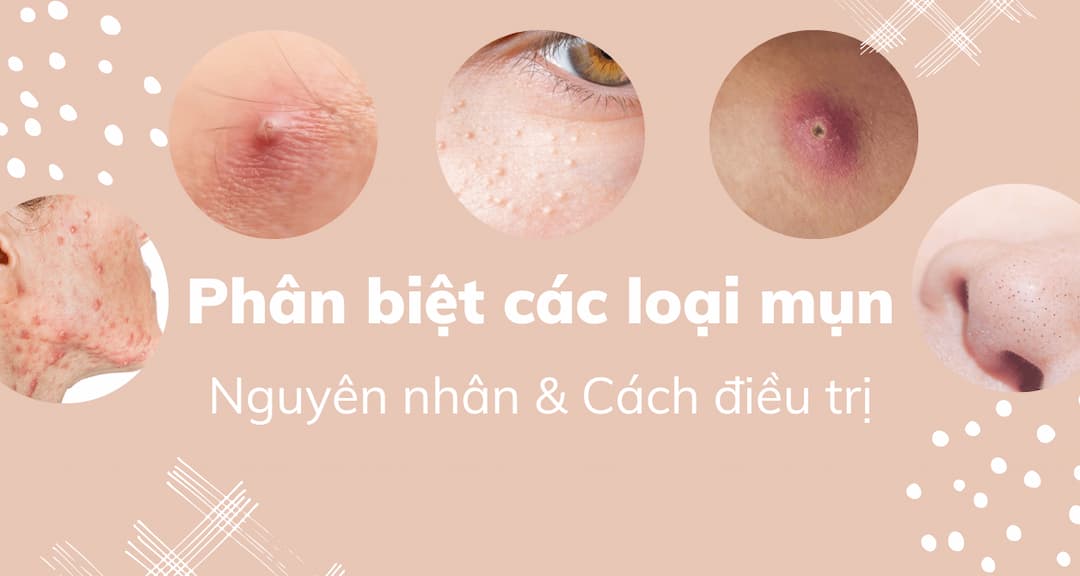 Phân biệt các loại mụn trứng cá viêm