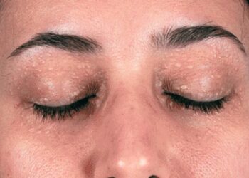 Chế độ ăn uống sau khi đốt mụn thịt