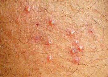 Đặc trưng của viêm nang lông là tình trạng sưng viêm, nổi mụn nhọt ứ mủ trong các nang lông… khiến người bệnh ngứa ngáy, khó chịu