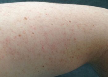 Các nốt đỏ nổi sần trên da, bên trong có lông mọc ở giữa và viêm mủ là biểu hiện rõ nét nhất của bệnh viêm nang lông tay