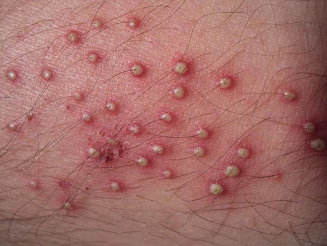 Vi khuẩn kí sinh trên da có thể là nguyên nhân sinh ra các đốm viêm mủ trên da