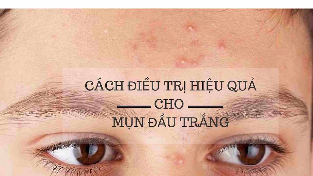 Cách điều trị mụn đầu trắng hiệu quả