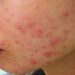 Cách khắc phục tình trạng viêm lỗ chân lông ở mặt