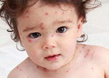 Tiêm vaccine phòng ngừa bệnh thủy đậu