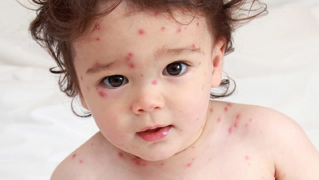 Tiêm vaccine phòng ngừa bệnh thủy đậu