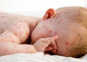 Biến chứng nguy hiểm bệnh thủy đậu