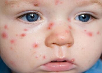 Thủy đậu kiêng gì để bệnh nhanh khỏi nhất?
