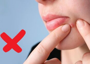 Sử dụng các sản phẩm trị mụn không kê đơn