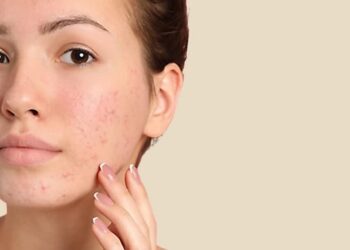 Nặn mụn có nên hay không?