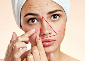 Làm sạch vùng da chuẩn bị nặn mụn