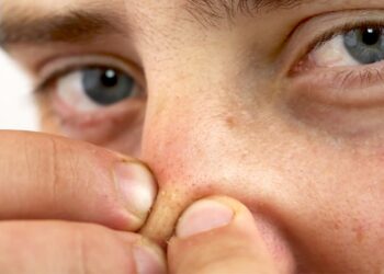 Hiệu quả trị mụn đầu đen bằng mật ong