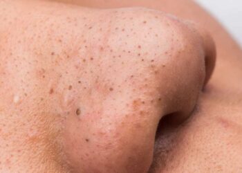 Cách trị mụn đầu đen cho da khô và các loại da khác