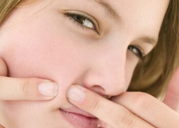 Cách trị mụn đầu đen dứt điểm tại nhà