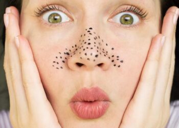 Cách trị mụn đầu đen bằng chanh