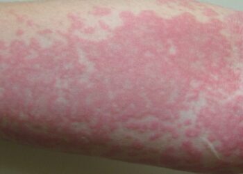 Nổi mề đay nguy hiểm không?