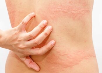 Cách duy trì nổi mề đay sau khi kiêng