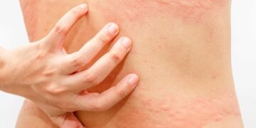 Cách duy trì nổi mề đay sau khi kiêng