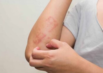 Nguyên nhân gây ra mề đay