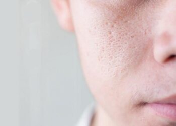 Cách điều trị sẹo rỗ bằng thủ thuật