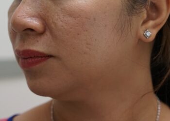 Cách làm sạch vùng bị sẹo rỗ trước khi điều trị