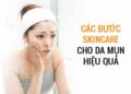 Tìm hiểu kỹ các bước skincare cho da mụn