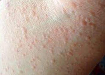 Da bị dị ứng và vô vàn những tai hại ẩn nấp ở đằng sau