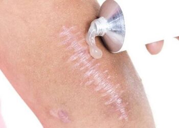 Kem trị sẹo giúp phần da sẹo phục hồi như ban đầu