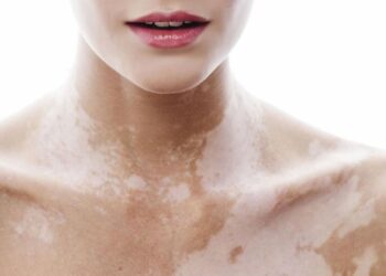 Bệnh bạch biến là bệnh như thế nào?