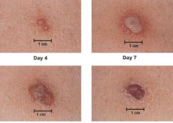 Các dấu hiệu ở người bị thủy đậu