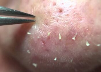 Ngăn ngừa loại mụn này khá đơn giản