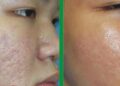 Cần biết những đặc điểm nhận dạng nào về sẹo rỗ?