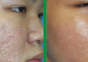 Cần biết những đặc điểm nhận dạng nào về sẹo rỗ?