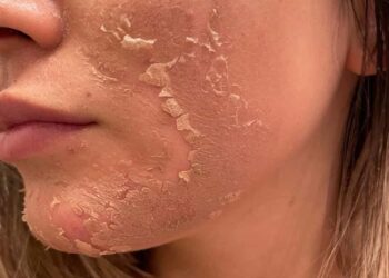 Peel da hoá học là gì?