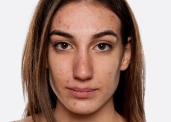 Mụn viêm sưng đỏ là gì?