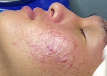 Mụn viêm là gì?