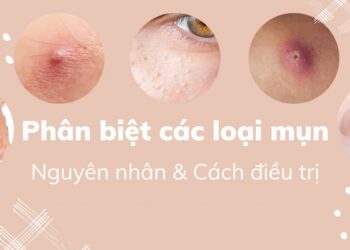 Phân biệt các loại mụn trứng cá viêm