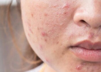 Chú ý chế độ ăn uống là cách phòng tránh mụn trứng cá