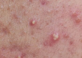 Biến chứng của mụn đầu trắng gây viêm màng não